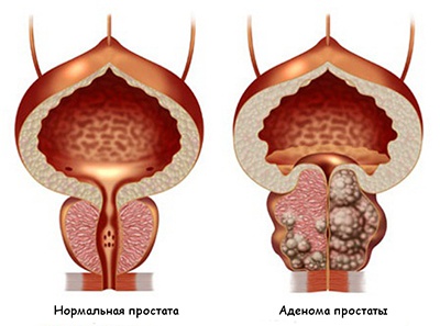 Analgezic pentru prostatită și uretrită